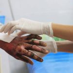 Treating Second-Degree Burns Better with Innovative Topical Antibiotics